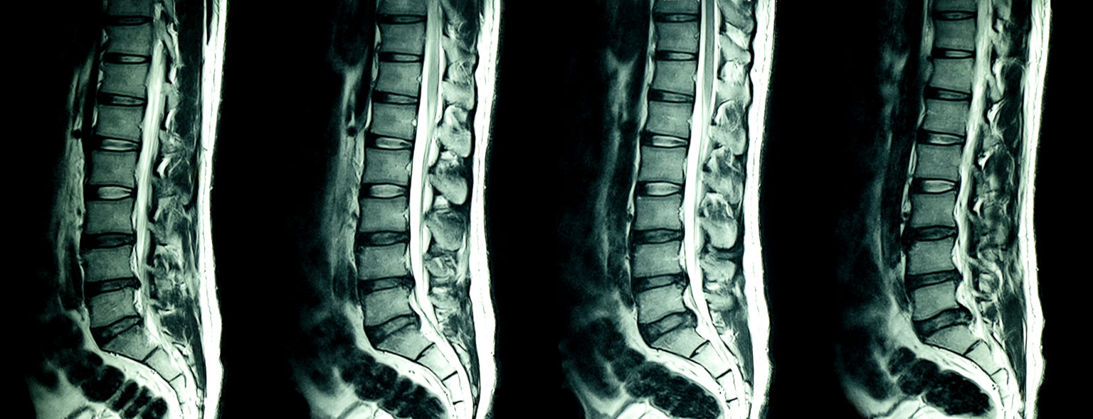 chirobedic spine align
