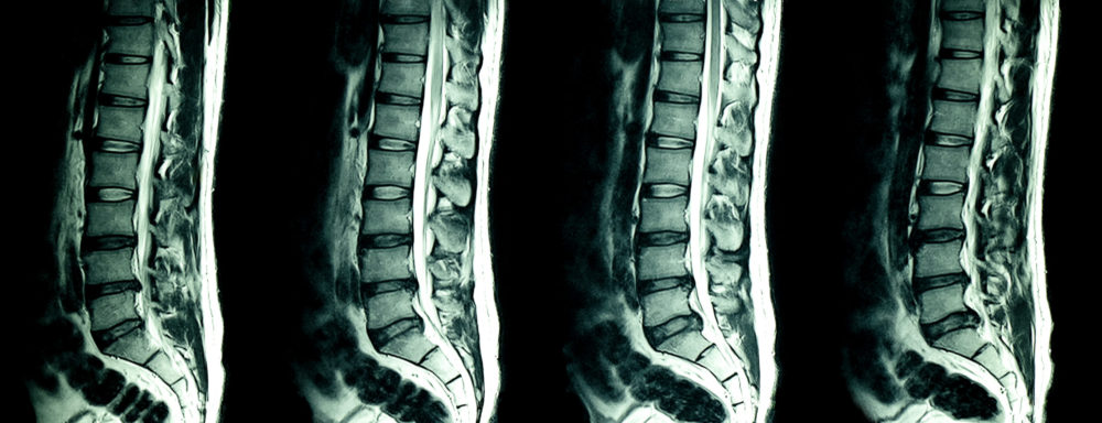 Vertiflex Implant | Lumbar Spinal Stenosis | Align Interventional Pain
