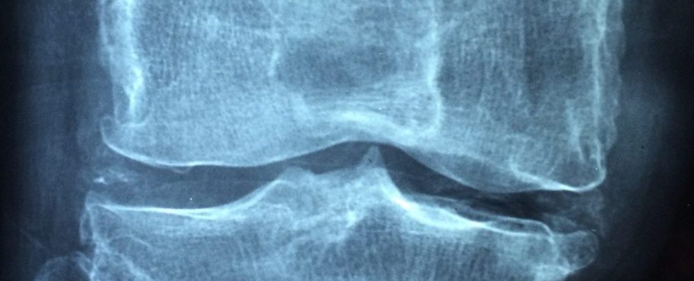 Radiofrequency Ablation