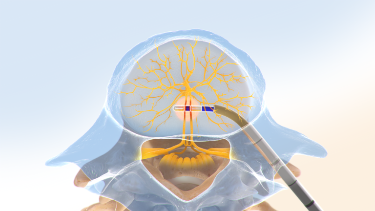 Basivertebral Nerve Ablation (Intracept) | Align Interventional Pain